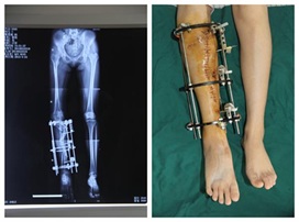 نتیجه تصویری برای عمل جراحی برای پاهای پرانتزی
