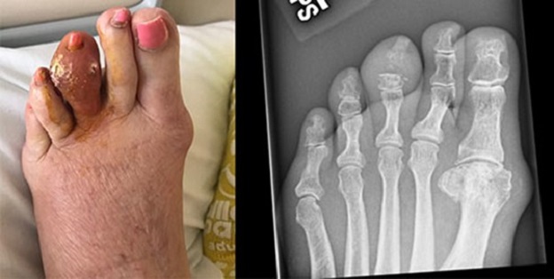 آزمایشات و تشخیص نقرس