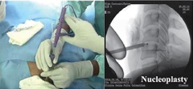 مراحل جراحی بسته دیسک گردن با لیزر نوکلئوتومی