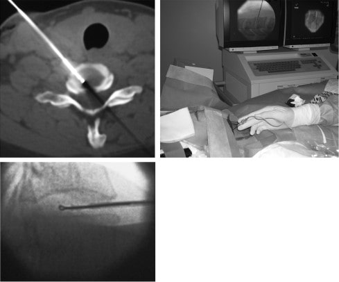 نتایج جراحی بسته دیسک گردن با لیزر نوکلئوتومی